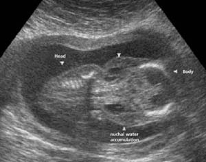 Fig.28 Hygroma colli in